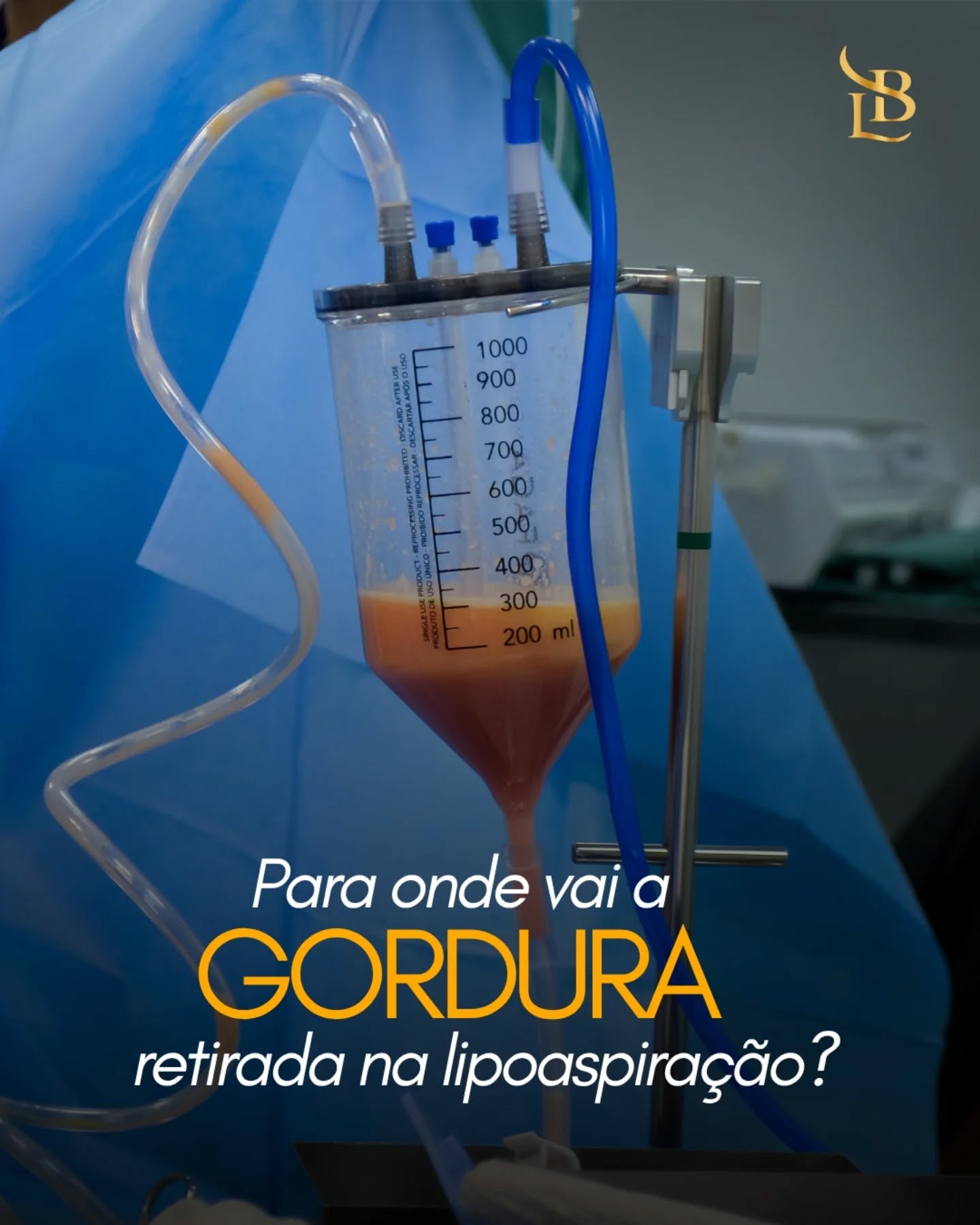 “Para onde vai a gordura retirada na lipoaspiração?” 🤔

Muita gente acredita que a gordura simplesmente “desaparece”, mas existe um processo por trás disso.
Durante a lipoaspiração, a gordura é removida através de cânulas específicas e armazenada em recipientes estéreis durante o procedimento.

Em alguns casos, essa gordura pode até ser reaproveitada para enxertos corporais, como glúteos ou determinadas regiões do corpo — sempre após uma avaliação adequada.
Mas é importante lembrar:
A lipoaspiração NÃO é um método de emagrecimento. Ela é indicada para remover gordura localizada e melhorar o contorno corporal. ✨
Cada corpo responde de uma forma, e o resultado final também depende do pós-operatório e dos cuidados após a cirurgia.

Salve este post para entender mais sobre o procedimento 💉

.
.
.

 ☎ (47) 9211-0040

📍 Rua Amadeu Felipe da Luz, 228 – Centro, Indaial/SC – Clínica SPES
👨‍⚕️ Dr. Lucas Baptista – CRM/SC 21411 | RQE 21645
🌐 drlucasbaptista.com.br

Clínica onde atendo: @spesclinica
Hospital onde realizo as cirurgias: @hbr.indaial
Minha enfermeira e assistente: @luana_finardii
Nossa instrumentadora e Téc. de Enfermagem: @myblessing_by_fe
Nosso Anestesiologista: @drclaudiokroda