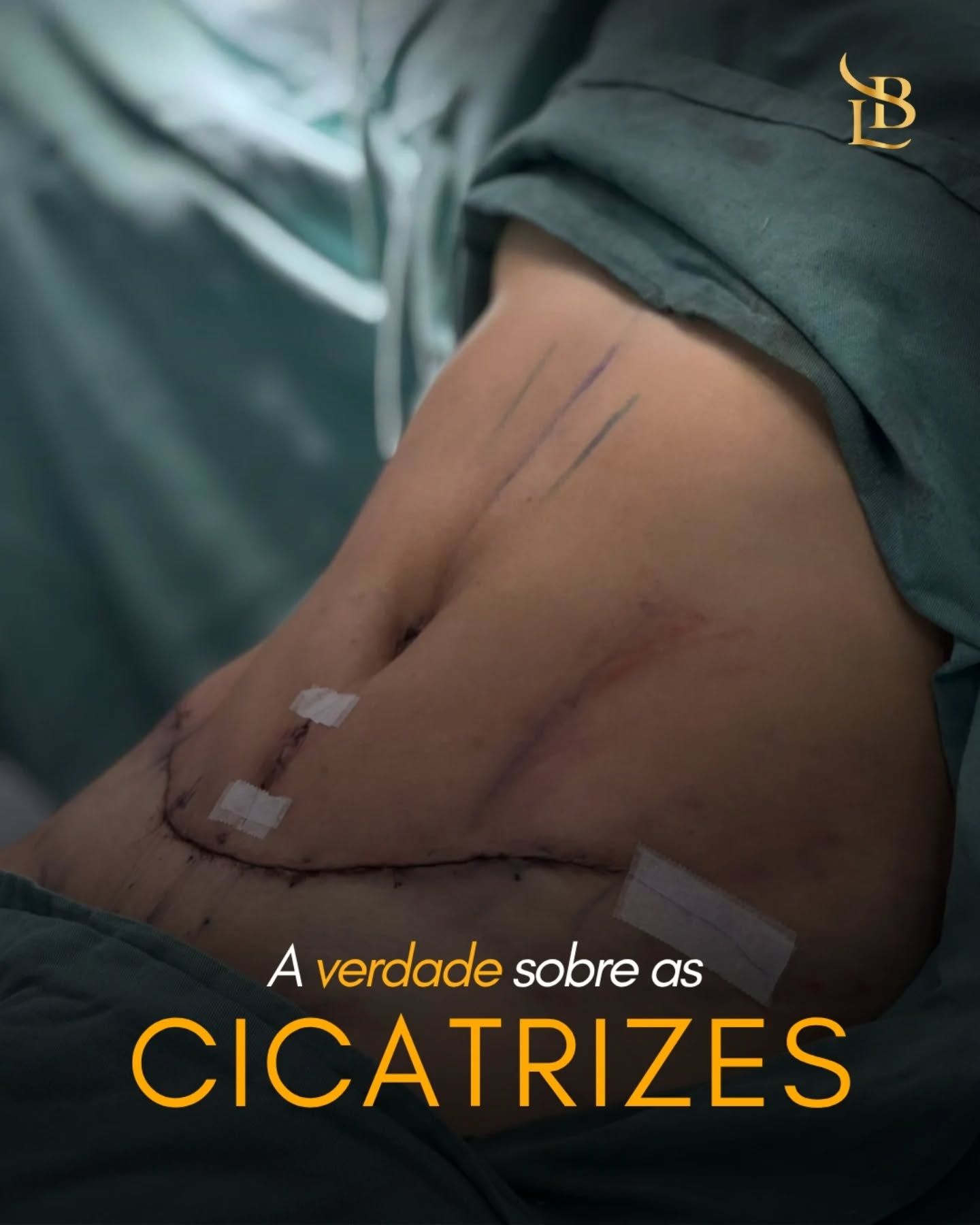 ❕A verdade por trás das cicatrizes, é que quando vistas pela primeira vez após a cirurgia, pode assustar o paciente, pois estará vermelho, inchado, marcado... "Feias". 
Um dos primeiros pensamentos é: " vai ficar assim depois?!". Dá um impacto. Dá dúvida. Dá medo de ter feito a escolha errada.
Mas o que pouca gente mostra é que esse não é o resultado final — é só o começo do processo.
Leve em consideração que seu corpo acaba de passar por um processo delicado e sensível, e ele precisa de tempo para se recuperar. 

Cicatrização exige cuidado e paciência. O corpo precisa se adaptar novamente. E aquela aparência inicial, que tanto incomoda, vai mudando aos poucos.

Se você está passando por isso agora, respira: o que você está vendo hoje não define o resultado de amanhã.
Agora, se ainda não realizou sua cirurgia e está com medo de uma marca irreversível, marque uma consulta comigo. Assim teremos tempo de conversarmos e tirar todas suas dúvidas e inseguranças. Assim, terá certeza se deseja ou não fazer a cirurgia. 

Entre em contato: 47 9211-0040

Lembre-se: 
Nem toda beleza é imediata. Algumas precisam de tempo para se revelar. 💭

📍 Rua Amadeu Felipe da Luz, 228 – Centro, Indaial/SC – Clínica SPES
👨‍⚕️ Dr. Lucas Baptista – CRM/SC 21411 | RQE 21645
🌐 drlucasbaptista.com.br

Clínica onde atendo: @spesclinica
Hospital onde realizo as cirurgias: @hbr.indaial
Minha enfermeira e assistente: @luana_finardii
Nossa instrumentadora e Téc. de Enfermagem: @myblessing_by_fe
Nosso Anestesiologista: @drclaudiokroda