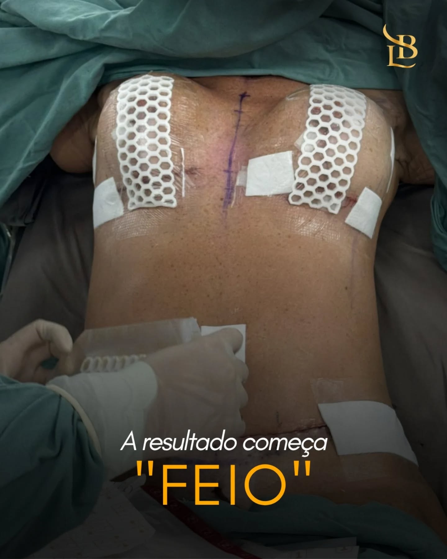 O que você está vendo aqui não é o resultado final.

É o pós-imediato — com inchaço, curativos e um corpo que ainda está reagindo à cirurgia.

O inchaço faz parte do processo. É uma resposta natural do organismo, que envia líquidos e células para iniciar a cicatrização. Por isso, a região pode parecer maior, endurecida ou até assimétrica nesse momento.

Nas primeiras 48 a 72 horas, esse inchaço tende a ser mais intenso. Depois, começa a regredir gradualmente… mas o resultado real leva semanas — e até meses — para aparecer.

Por isso, é normal estranhar no começo.
O corpo ainda está em processo, e tudo aqui evolui com o tempo.

Respeitar cada fase do pós-operatório é essencial para um bom resultado. 🤍

.
.
.

 ☎ (47) 9211-0040

📍 Rua Amadeu Felipe da Luz, 228 – Centro, Indaial/SC – Clínica SPES
👨‍⚕️ Dr. Lucas Baptista – CRM/SC 21411 | RQE 21645
🌐 drlucasbaptista.com.br

Clínica onde atendo: @spesclinica
Hospital onde realizo as cirurgias: @hbr.indaial
Minha enfermeira e assistente: @luana_finardii
Nossa instrumentadora e Téc. de Enfermagem: @myblessing_by_fe
Nosso Anestesiologista: @drclaudiokroda

#posoperatorio #cirurgiaplastica #recuperacao #posimediato #inchaço cicatrizacao medicinaestetica