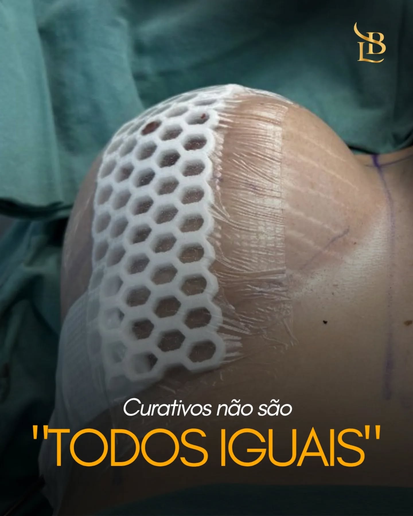 Nem todo curativo é igual — e isso pode impactar diretamente na sua recuperação.

Após uma cirurgia plástica, o curativo não serve apenas para “cobrir” a região operada. Ele tem funções essenciais no processo de cicatrização e no resultado final.

✔️ Proteção da incisão: cria uma barreira contra bactérias e reduz o risco de infecção
✔️ Controle do inchaço: alguns curativos ajudam a manter a área mais estável
✔️ Auxílio na cicatrização: o tipo certo de material favorece uma recuperação mais eficiente
✔️ Modelagem da região: em alguns casos, o curativo também ajuda a manter o contorno adequado

Cada cirurgia exige um tipo específico de curativo, com técnica e materiais apropriados. Por isso, o acompanhamento profissional no pós-operatório é tão importante quanto o procedimento em si.

Porque no final, não é só sobre a cirurgia — é sobre como você se recupera dela.

.
.
.

 ☎(47) 9211-0040

📍 Rua Amadeu Felipe da Luz, 228 – Centro, Indaial/SC – Clínica SPES
👨‍⚕️ Dr. Lucas Baptista – CRM/SC 21411 | RQE 21645
🌐 drlucasbaptista.com.br

Clínica onde atendo: @spesclinica
Hospital onde realizo as cirurgias: @hbr.indaial
Minha enfermeira e assistente: @luana_finardii
Nossa instrumentadora e Téc. de Enfermagem: @myblessing_by_fe
Nosso Anestesiologista: @drclaudiokroda