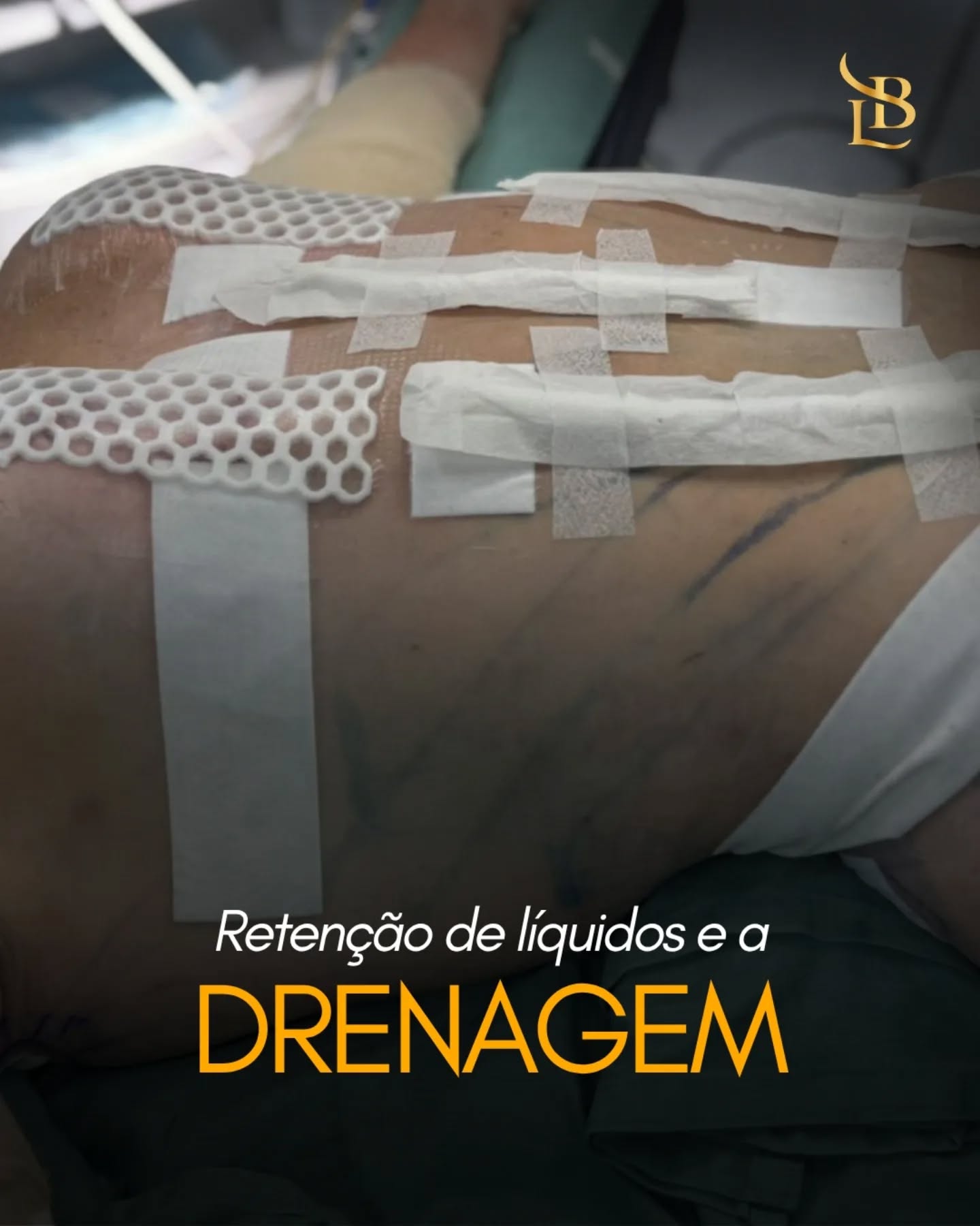 Esse é um dos primeiros momentos do pós-operatório imediato. ✨
Após a cirurgia, o corpo inicia um processo intenso de recuperação, e é justamente nessa fase que cuidados como a drenagem linfática se tornam importantes.
Nos primeiros dias, é comum ocorrer inchaço, retenção de líquidos e desconforto na região operada. A drenagem auxilia o organismo nesse processo, ajudando na circulação, redução do edema e recuperação dos tecidos.
Cada etapa do pós-operatório influencia diretamente no resultado final — e o cuidado começa muito antes do resultado aparecer.

.
.
.

 ☎ (47) 9211-0040

📍 Rua Amadeu Felipe da Luz, 228 – Centro, Indaial/SC – Clínica SPES
👨‍⚕️ Dr. Lucas Baptista – CRM/SC 21411 | RQE 21645
🌐 drlucasbaptista.com.br

Clínica onde atendo: @spesclinica
Hospital onde realizo as cirurgias: @hbr.indaial
Minha enfermeira e assistente: @luana_finardii
Nossa instrumentadora e Téc. de Enfermagem: @myblessing_by_fe
Nosso Anestesiologista: @drclaudiokroda