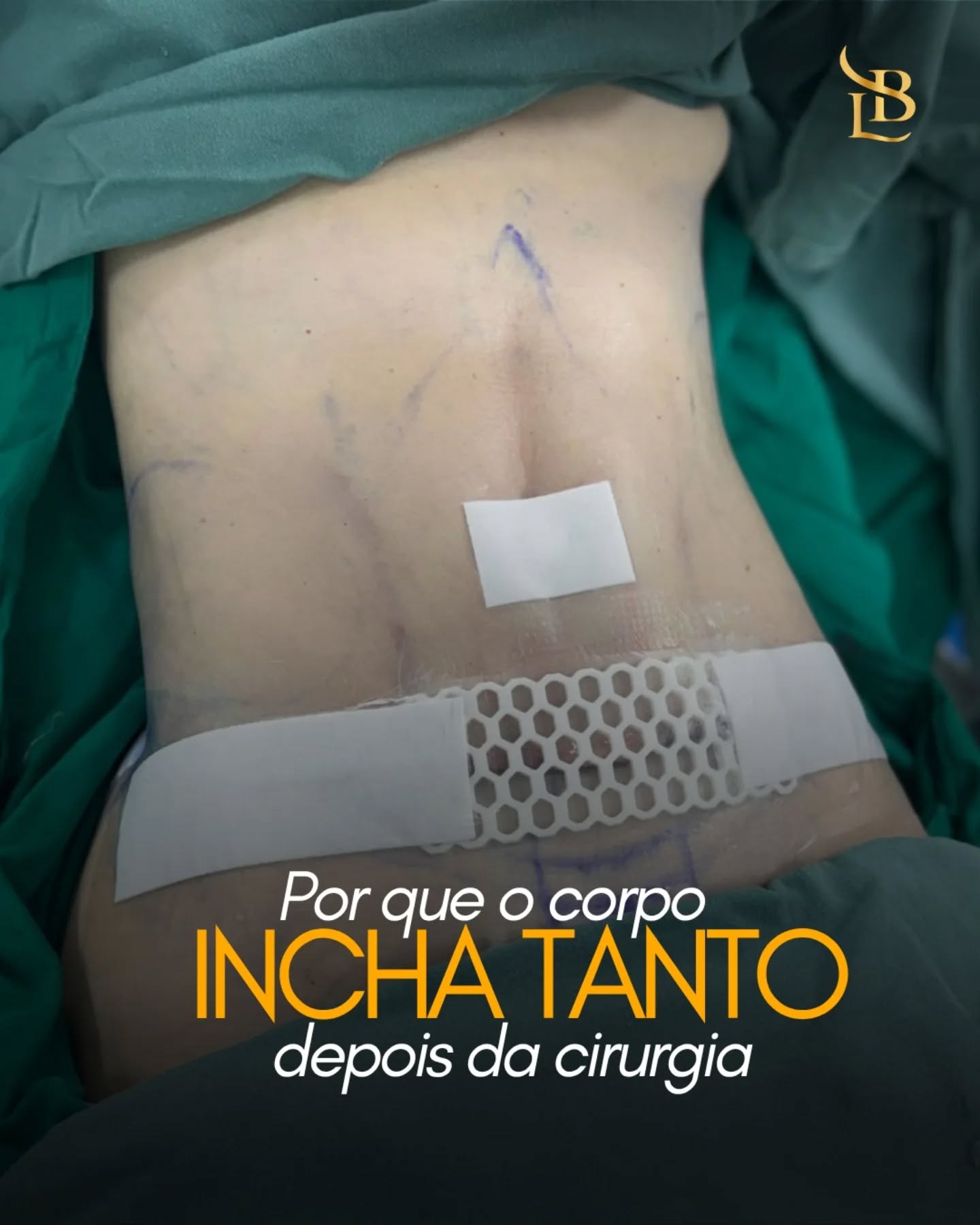 “Por que o corpo incha tanto depois da cirurgia?”
Porque ele entende que passou por um trauma, mesmo quando tudo ocorreu perfeitamente.

O inchaço faz parte da resposta natural do organismo durante a cicatrização. Após a cirurgia, o corpo aumenta a circulação na região operada, retém líquidos e inicia um processo intenso de recuperação interna.

Por isso, no pós-operatório imediato, é comum aparecer:
• edema
• sensação de rigidez
• assimetrias temporárias
• roxos
• aumento de volume

E não: isso não significa que “deu errado”.
Cada corpo responde em um ritmo diferente. O resultado final não aparece em dias, mas sim aos poucos, conforme o organismo se recupera.
Por trás de cada resultado bonito, existe um processo que também precisa ser respeitado.

.
.
.

 ☎ (47) 9211-0040

📍 Rua Amadeu Felipe da Luz, 228 – Centro, Indaial/SC – Clínica SPES
👨‍⚕️ Dr. Lucas Baptista – CRM/SC 21411 | RQE 21645
🌐 drlucasbaptista.com.br

Clínica onde atendo: @spesclinica
Hospital onde realizo as cirurgias: @hbr.indaial
Minha enfermeira e assistente: @luana_finardii
Nossa instrumentadora e Téc. de Enfermagem: @myblessing_by_fe
Nosso Anestesiologista: @drclaudiokroda