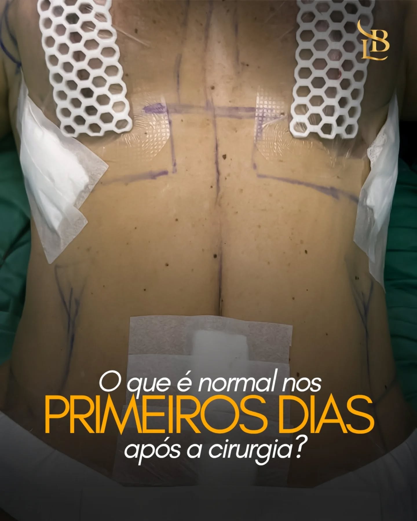 Os primeiros dias após uma cirurgia plástica costumam gerar muitas dúvidas. Afinal, o que é normal sentir nesse período?

Inchaço, sensação de peso, áreas adormecidas, pequenos hematomas e um certo desconforto fazem parte da resposta natural do organismo ao procedimento. Isso acontece porque o corpo está iniciando um complexo processo de cicatrização e recuperação dos tecidos.

Cada paciente reage de uma forma, mas é importante entender que o pós-operatório imediato não representa o resultado final da cirurgia. Na verdade, essa é apenas a primeira etapa de uma transformação que continuará acontecendo nas próximas semanas e meses.

Por isso, comparar sua recuperação com a de outras pessoas pode gerar expectativas irreais e ansiedade desnecessária. O mais importante é seguir as orientações médicas, respeitar os períodos de repouso e dar ao seu corpo o tempo necessário para se recuperar.

A recuperação também faz parte do tratamento. E cada dia de cuidado é um passo em direção ao resultado desejado. ✨

.
.
.

 ☎ (47) 9211-0040

📍 Rua Amadeu Felipe da Luz, 228 – Centro, Indaial/SC – Clínica SPES
👨‍⚕️ Dr. Lucas Baptista – CRM/SC 21411 | RQE 21645
🌐 drlucasbaptista.com.br

Clínica onde atendo: @spesclinica
Hospital onde realizo as cirurgias: @hbr.indaial
Minha enfermeira e assistente: @luana_finardii
Nossa instrumentadora e Téc. de Enfermagem: @myblessing_by_fe
Nosso Anestesiologista: @drclaudiokroda