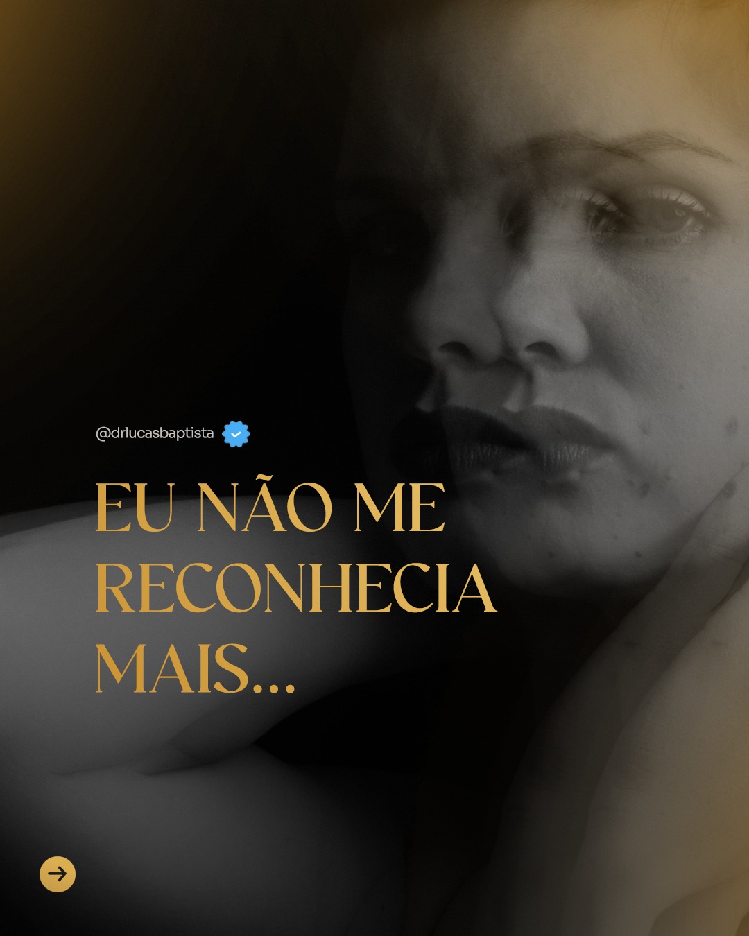 A cirurgia plástica, quando indicada e realizada com responsabilidade, não é sobre vaidade vazia. É sobre escolha. Sobre autoestima. Sobre fechar um ciclo e iniciar outro com segurança e acolhimento. ✨

Dr. Lucas Baptista - Cirurgião Plástico | CRM/SC 21411 | RQE 21645