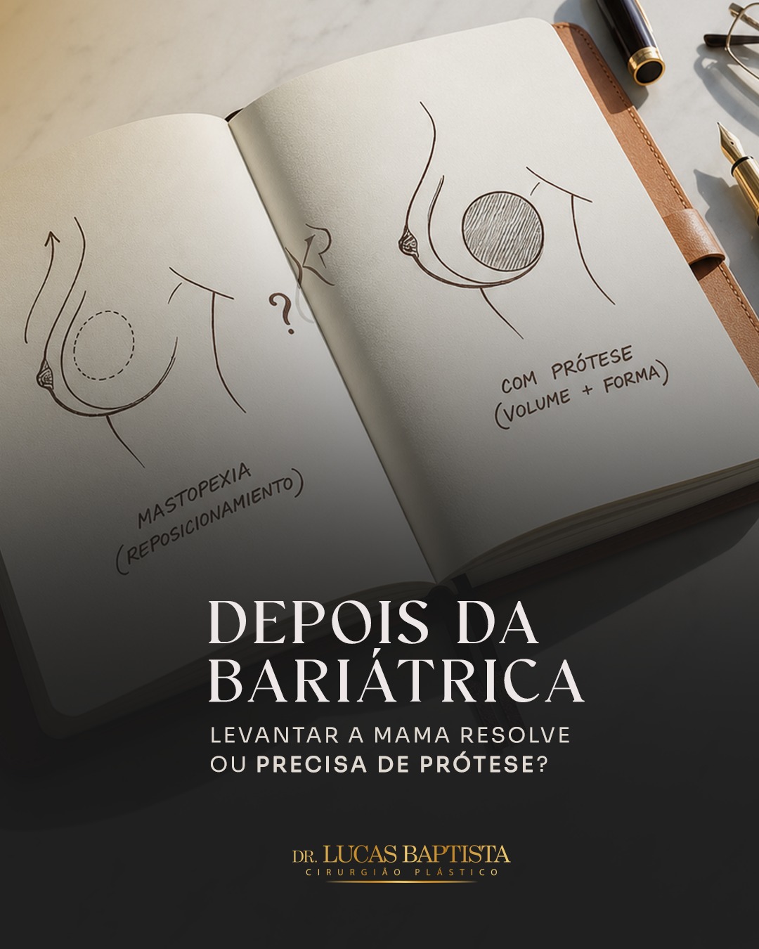 Após a bariátrica, é comum as mamas apresentarem flacidez, queda e perda de volume. A mastopexia pode ser suficiente em alguns casos, enquanto a prótese pode ajudar a recuperar volume e sustentação quando há maior esvaziamento. A escolha deve ser personalizada, considerando o corpo atual e as expectativas de cada mulher.

Dr. Lucas Baptista - Cirurgião Plástico | CRM/SC 21411 | RQE 21645