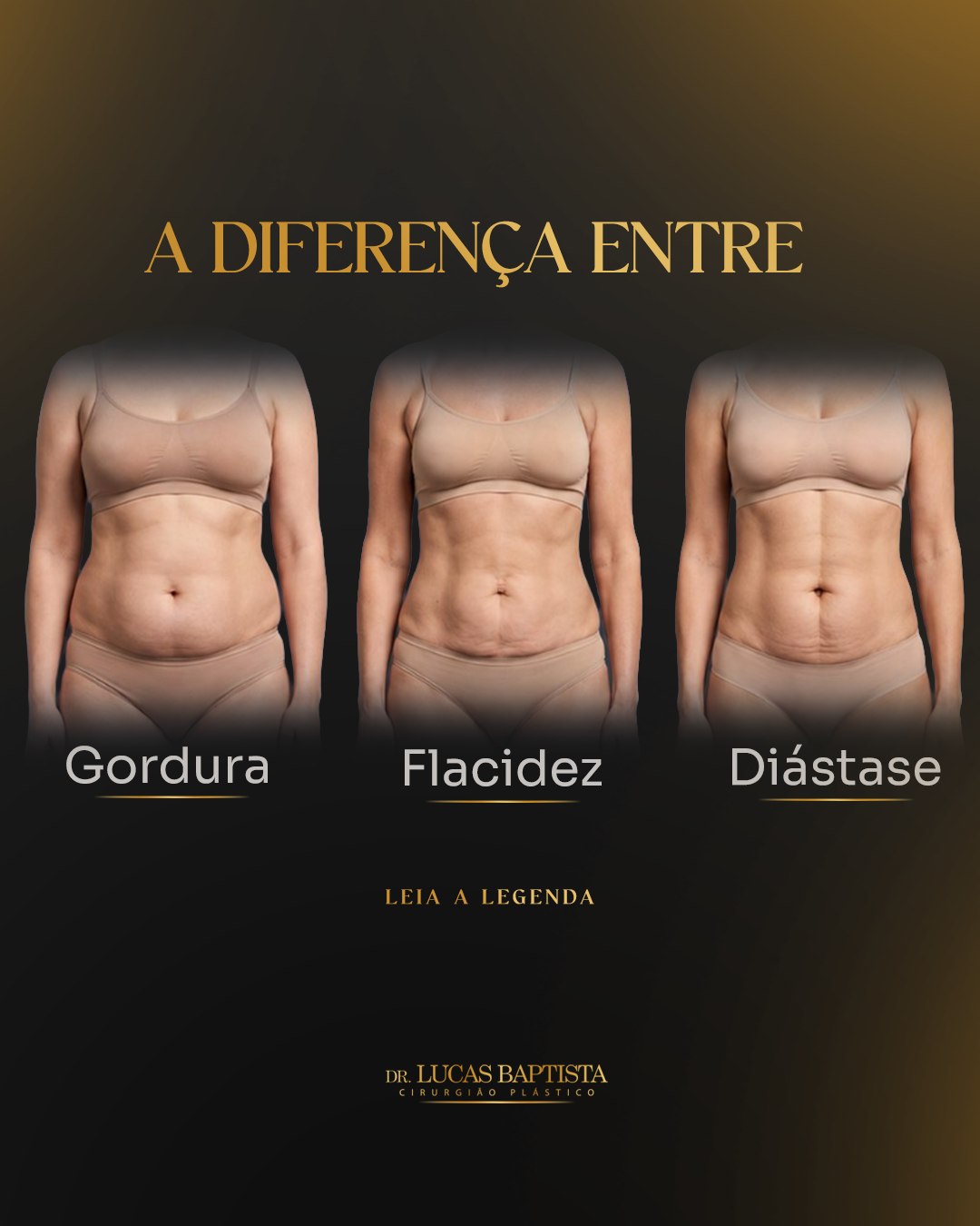 Nem todo volume no abdômen é gordura.

Ele pode estar relacionado a:
Gordura localizada: excesso de tecido adiposo sob a pele.
Flacidez: perda de firmeza e excesso de pele.
Diástase: afastamento dos músculos abdominais, que pode causar abaulamento.

Essas alterações também podem aparecer juntas. Por isso, apenas observar ou apertar a barriga não é suficiente para indicar o tratamento adequado.
Na cirurgia plástica, tudo começa com uma avaliação individualizada para entender o que está alterando o seu abdômen e quais opções fazem sentido para você.

Ficou com alguma dúvida? Conte nos comentários.

 
Dr. Lucas Baptista - Cirurgião Plástico | CRM/SC 21411 | RQE 21645