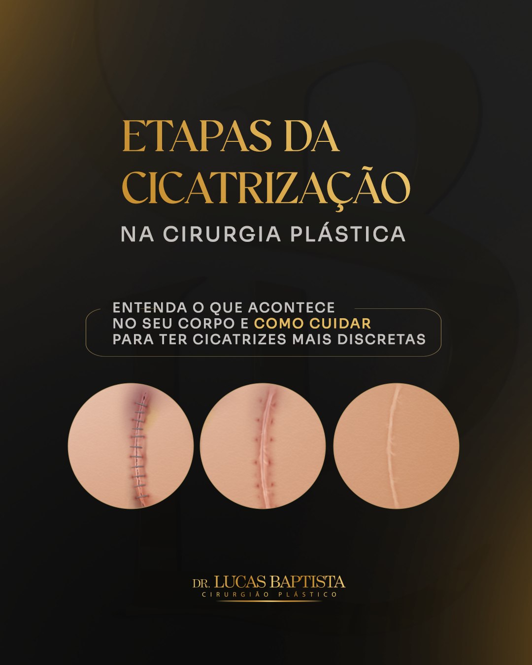 A cicatrização não acontece de uma hora para outra. Ela passa por diferentes fases, e cada etapa é essencial para que o organismo se recupere adequadamente. 🩺

Saber o que acontece durante esse processo pode ajudar você a entender melhor o pós-operatório e passar por essa fase com mais tranquilidade.

➡️ Arraste para o lado e descubra quais são as 3 principais fases da cicatrização.
Tem dúvidas sobre sua recuperação após a cirurgia? Nossa equipe está à disposição para orientar você.

Dr. Lucas Baptista - Cirurgião Plástico | CRM/SC 21411 | RQE 21645

—————————
Os resultados são individuais, portanto não podem ser replicados ou garantidos.
Qualquer cirurgia ou procedimento apresenta riscos. Tenha ciência dos riscos e da sua responsabilidade como paciente.