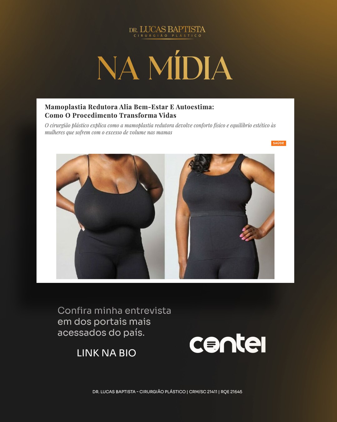 🎙️ Minha entrevista no Portal Contei: "Mamoplastia é sobre saúde e liberdade"
Em um bate-papo exclusivo com o portal, pude desmistificar a redução de mamas. Para mim, esse procedimento vai muito além da estética: é uma necessidade funcional para milhares de mulheres.
Confira os pontos principais da nossa conversa:

O Peso Real: Muitas pacientes convivem anos com dores crônicas e problemas de postura sem saber que a solução é cirúrgica. 

Proporção é a Chave: Meu foco não é seguir um padrão, mas encontrar o equilíbrio ideal para o biotipo de cada mulher. 

Recuperação: Com as técnicas atuais, o pós-operatório é mais tranquilo, exigindo cerca de 30 dias de cuidados.
"Reduzir o peso das mamas é devolver a autoconfiança."

Leia a entrevista completo no LINK DA BIO.

Dr. Lucas Baptista - Cirurgião Plástico | CRM/SC 21411 | RQE 21645