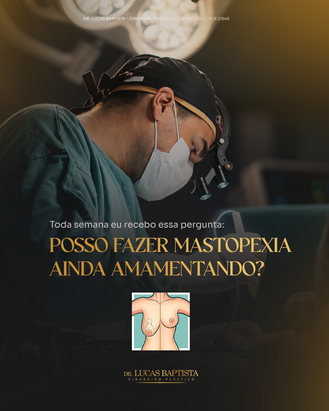 Toda semana alguma paciente me pergunta se dá pra fazer mastopexia ainda amamentando. A resposta é não.

O ideal é esperar alguns meses após o desmame, quando o corpo já estabilizou peso e formato, fazer antes disso pode comprometer o resultado, porque as mamas ainda vão mudar depois.

Se você já desmamou e quer entender se chegou a hora de fazer a sua cirurgia, fale com a minha equipe pelo WhatsApp (link na bio).

Dr. Lucas Baptista - Cirurgião Plástico | CRM/SC 21411 | RQE 21645

______________
Esta postagem tem caráter informativo e educativo, de acordo com a Resolução CFM nº 2.336/2023. Nenhum conteúdo deve ser interpretado como promessa de resultado. Toda cirurgia plástica envolve riscos. Cada organismo é único e a cirurgia é planejada de forma personalizada. O resultado final depende não apenas da técnica, mas também das características individuais do paciente. A escolha consciente e bem informada é o primeiro passo de qualquer transformação segura. Sempre consulte seu médico e tire todas as suas dúvidas.